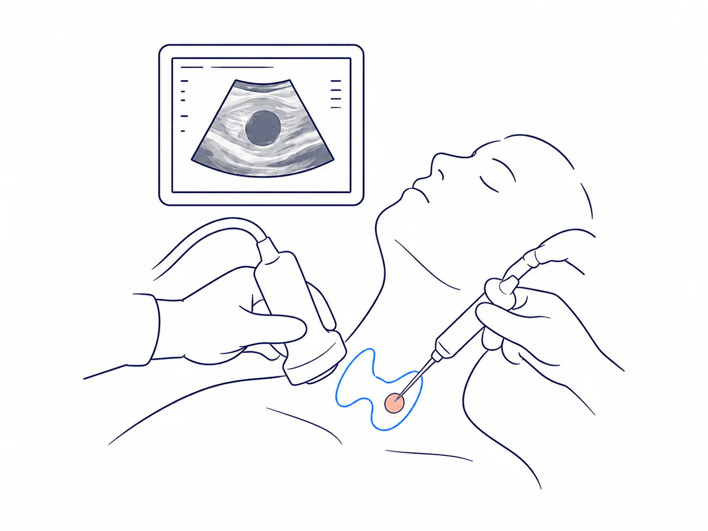 Illustration of ultrasound-guided needle placement during the procedure