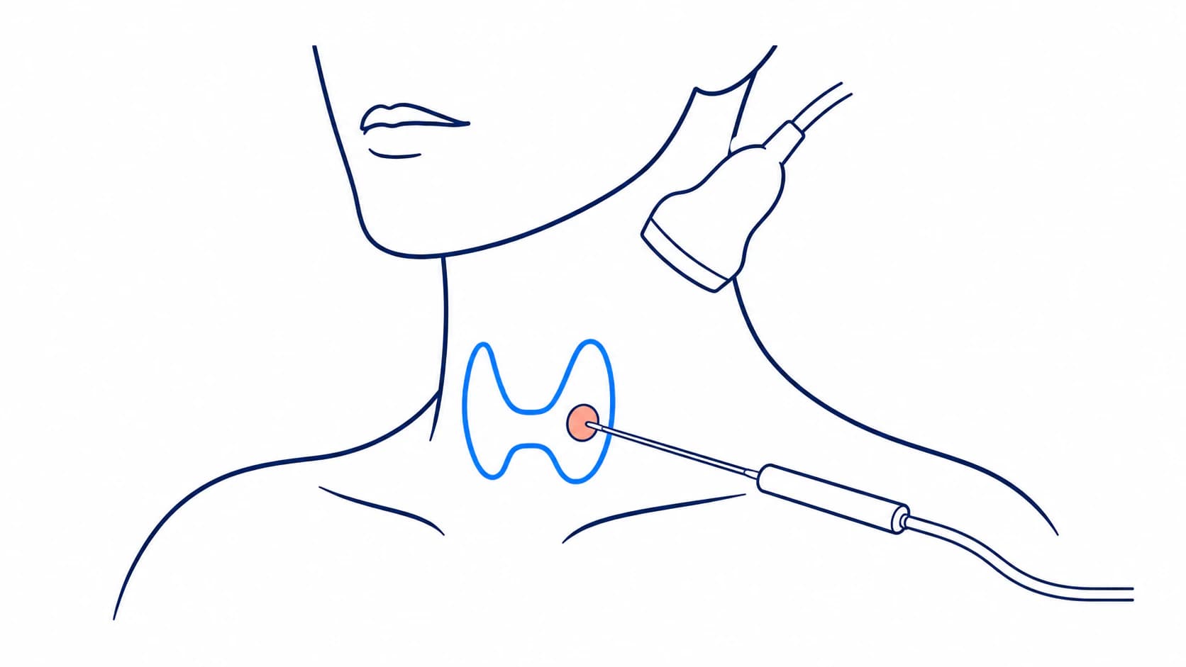 Line illustration of an ultrasound-guided needle delivering microwave energy to a thyroid nodule