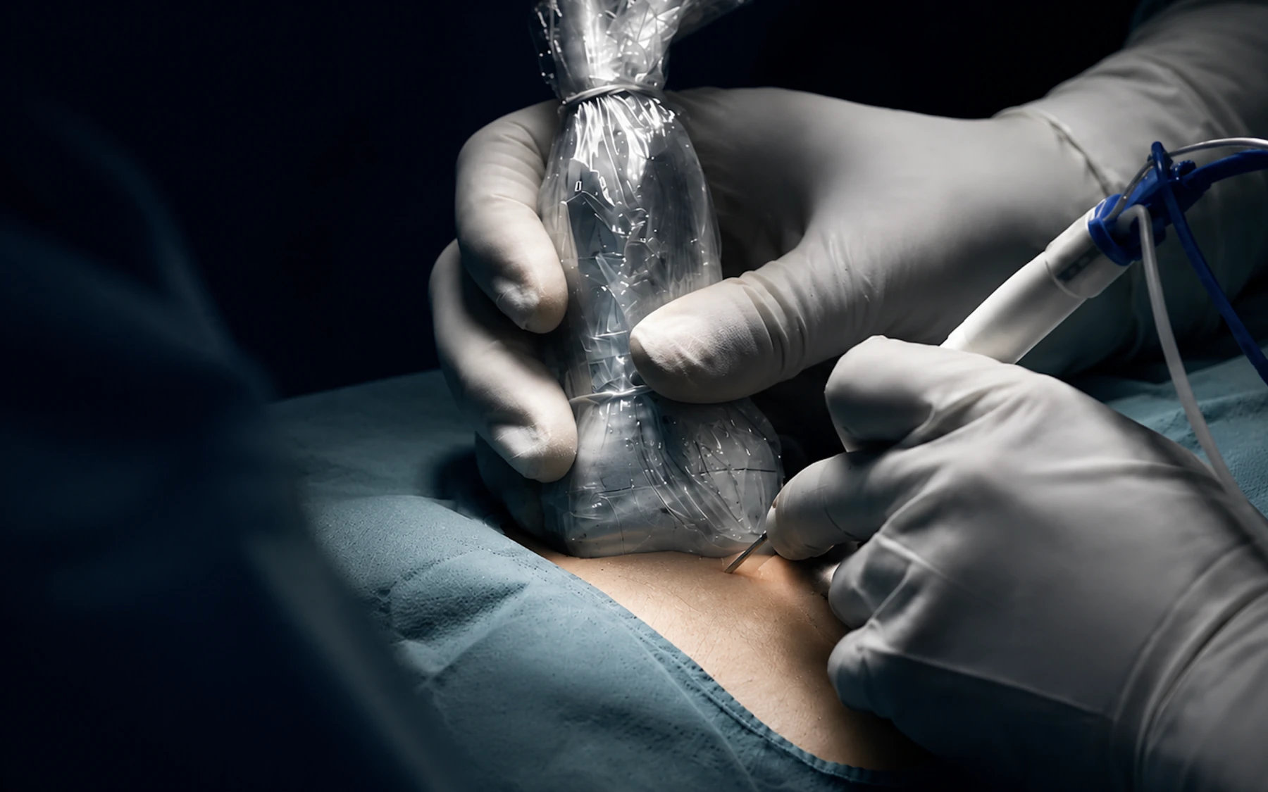 Ultrasound-guided percutaneous needle placement during a microwave ablation procedure