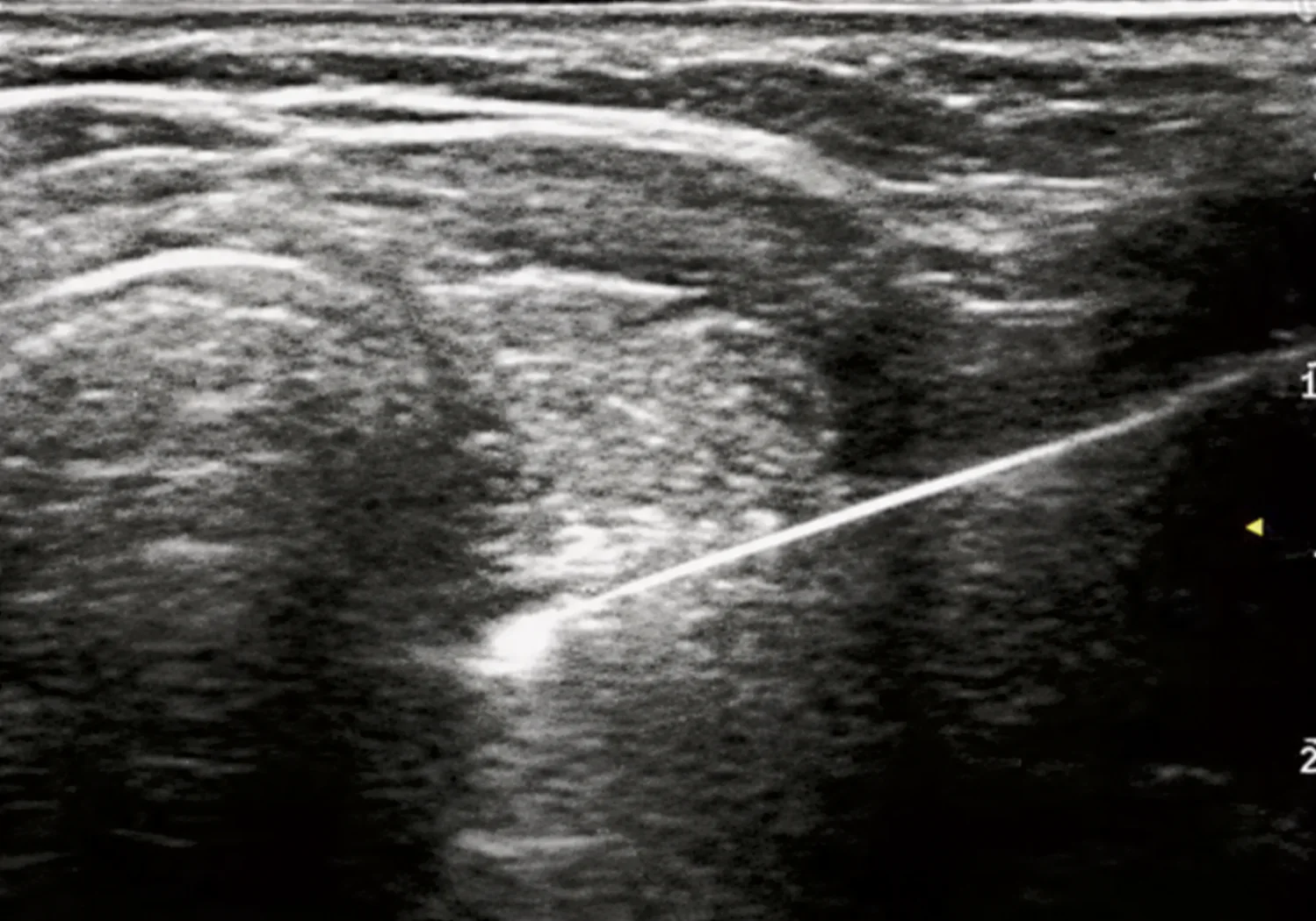 Intraprocedural ultrasound image showing the Baird MWA needle shaft tracking toward a thyroid nodule