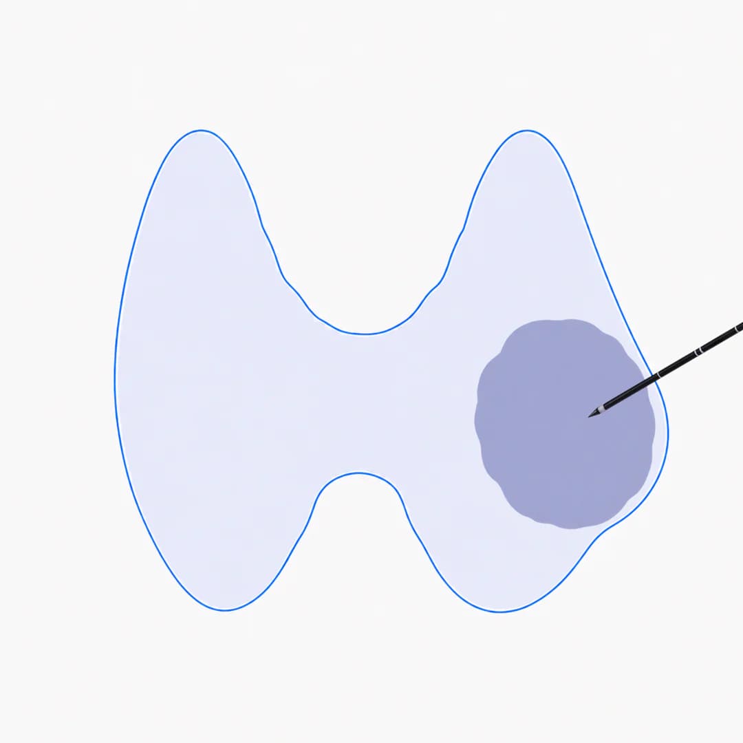 Illustration of ultrasound guiding a thin needle toward a targeted thyroid nodule