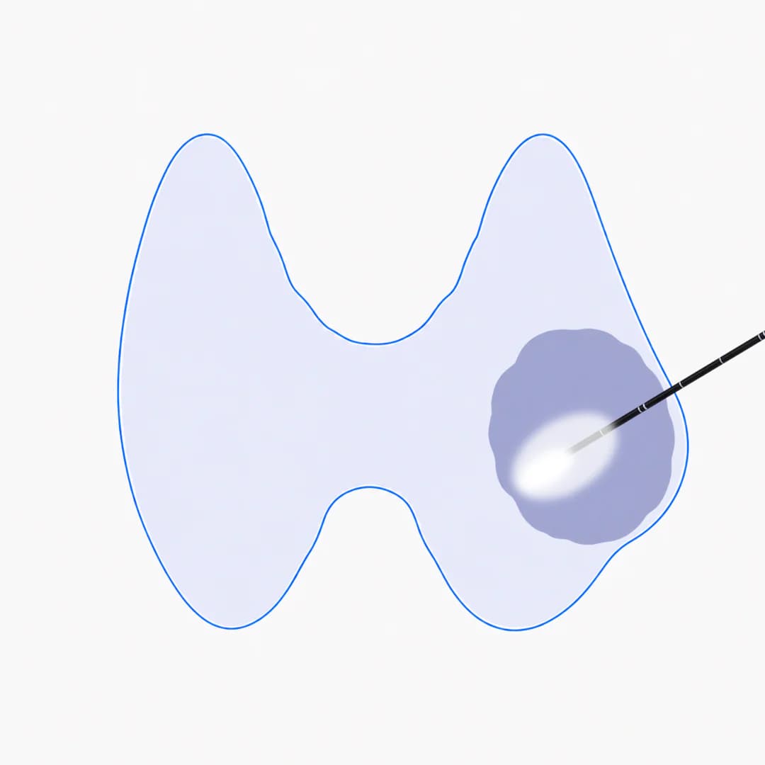 Illustration of a thin needle delivering microwave energy inside the thyroid nodule