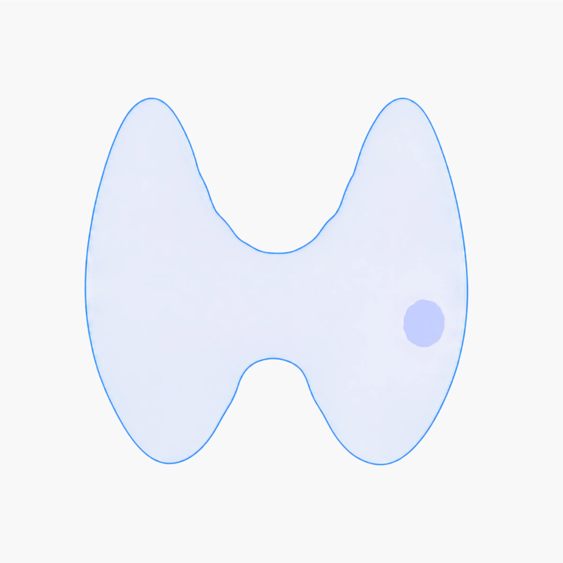 Illustration of a treated thyroid nodule gradually shrinking over time