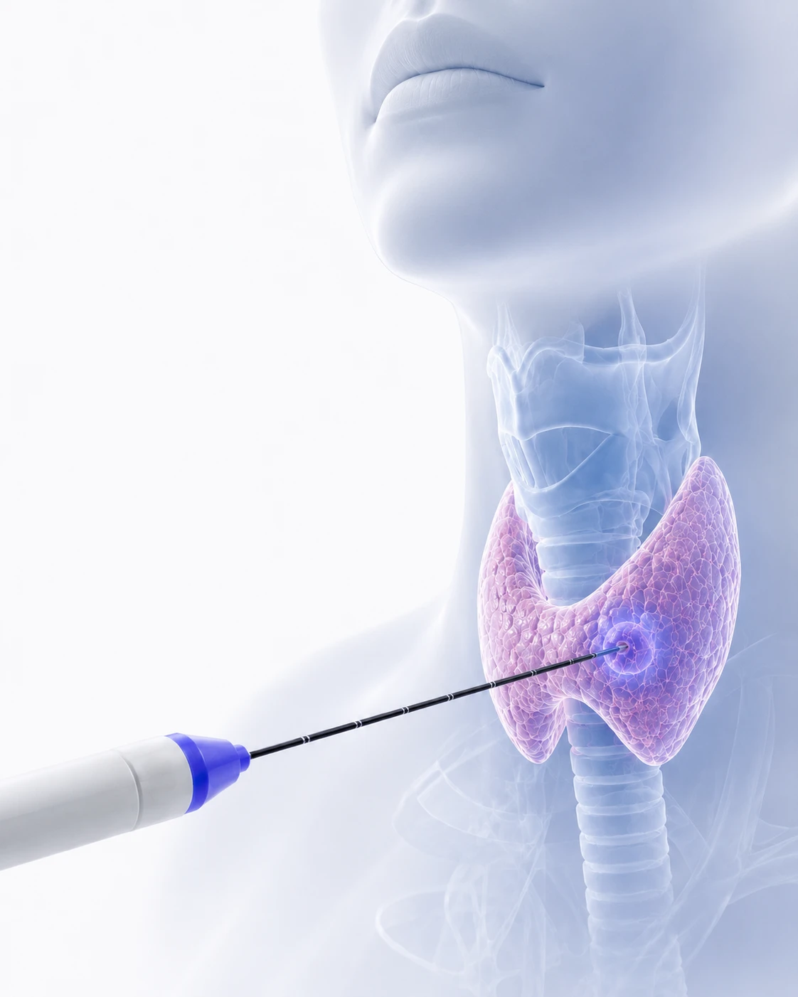 Illustration of a microwave ablation needle positioned in a thyroid nodule generating targeted heat