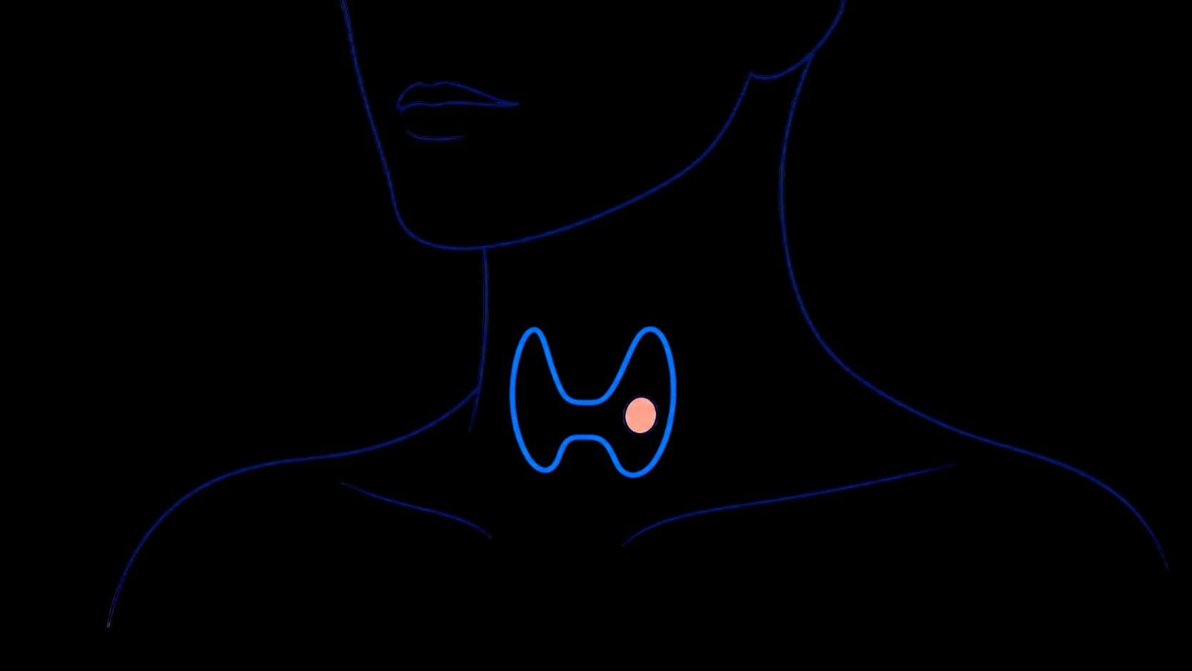 Line illustration of the thyroid gland in the neck with a small nodule highlighted